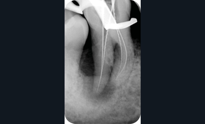 (c). Radiographie per-opératoire pendant le traitement endodontique