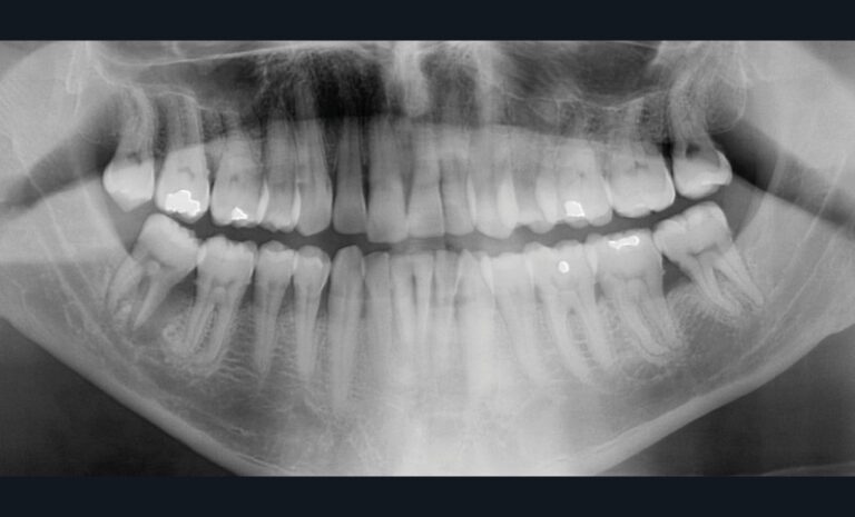 1. Radiographie panoramique d’une lésion parodontale englobant la racine mésiale au niveau de 47 (a).