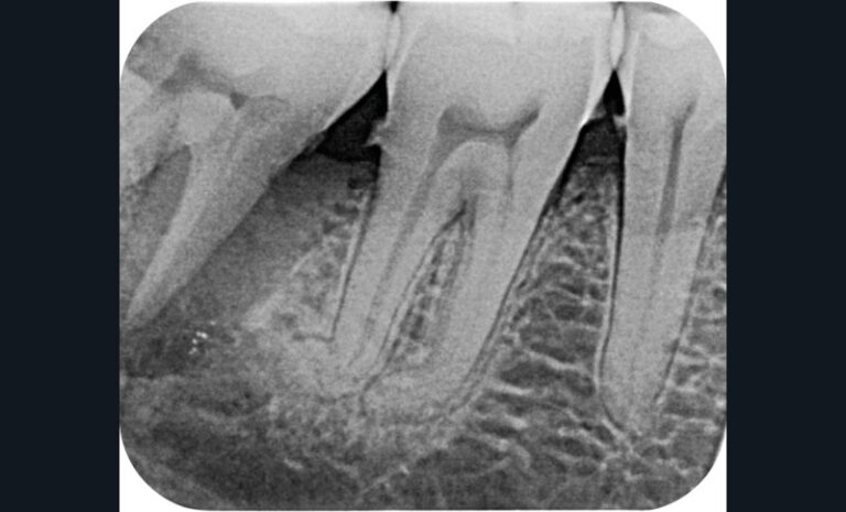 La dent 47 répond positivement aux tests de sensibilité pulpaire. Radiographie rétroalvéolaire montrant le défaut osseux au niveau de la racine mésiale de 47 (b).