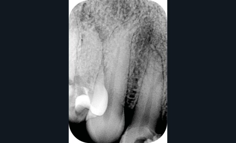 2. Mise en évidence d’un canal latéral présent dans le tiers apical, lors de la réalisation du traitement endodontique. Radiographie  pré-opératoire au niveau de 12 (a).