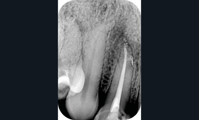 Radiographie post-opératoire au niveau de 12 (c).