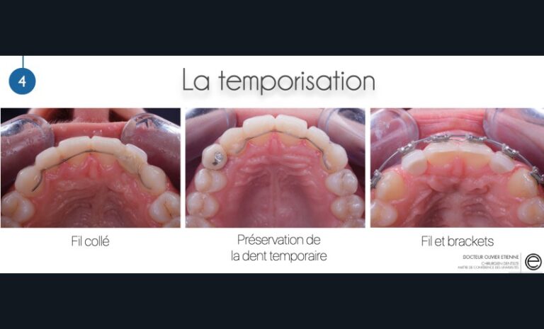 3. Solutions de temporisation envisageables pour les bridges cantilever antérieurs.