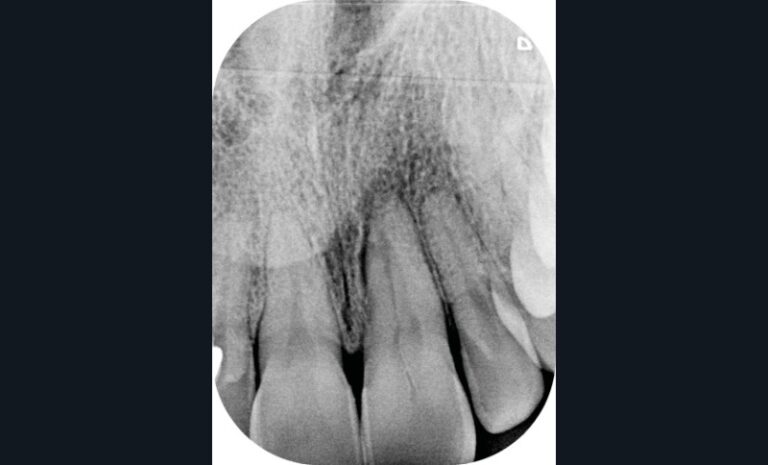 Traitement endodontique avec obturation ciment hydraulique silicate de calcium. Radiographie pré-opératoire (c),