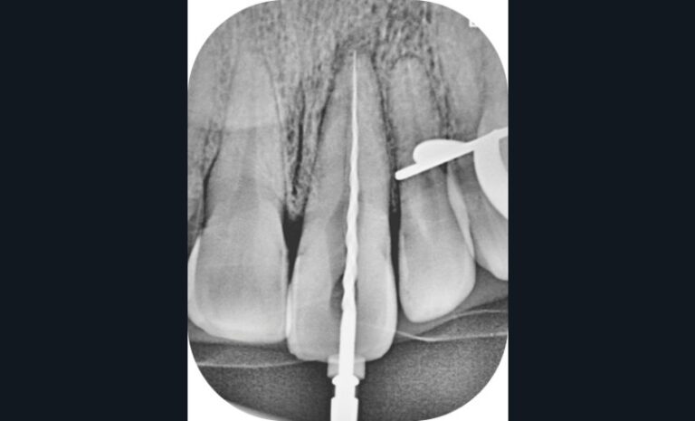 radiographie per-opératoire (d)