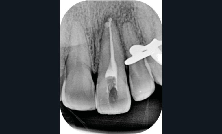 radiographie post-opératoire (e).