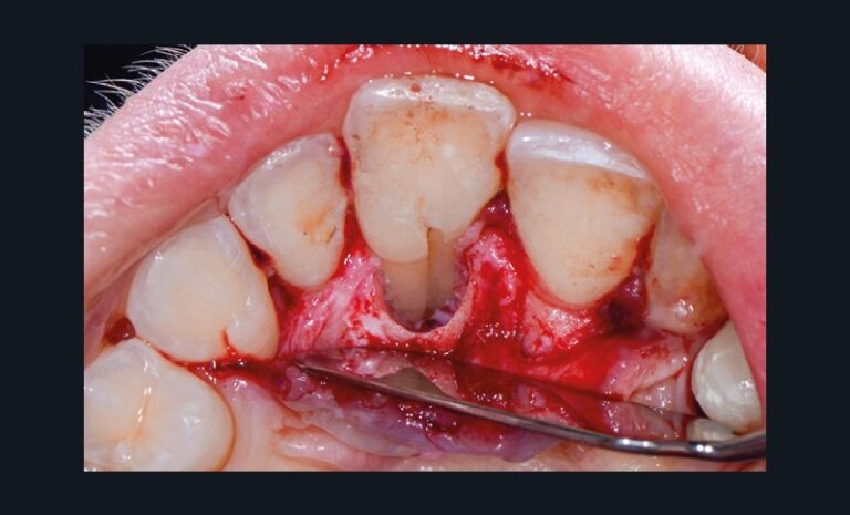 Accès et traitement chirurgical du sillon palato-gingival ; vue après décontamination (g)