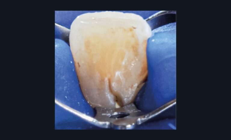 une chirurgie apicale a également été réalisée (obturation). Réalisation du composite sur la portion coronaire (j).