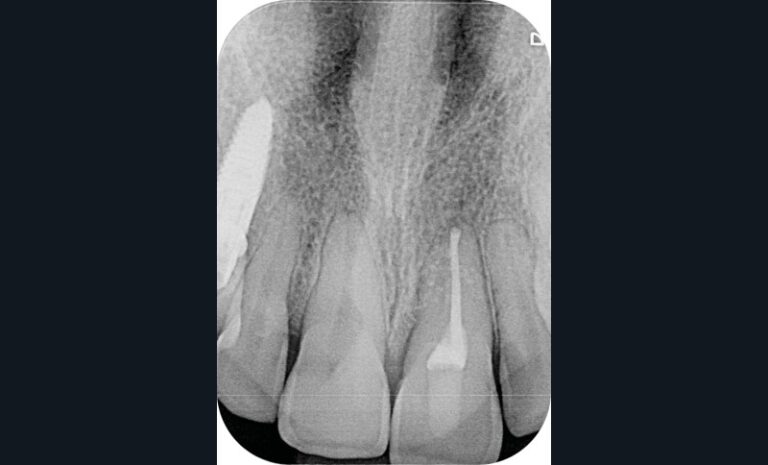 Contrôle radiographique à 2 ans (k)