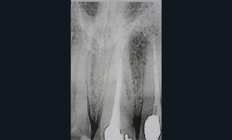 4. Radiographie pré-opératoire d’une résorption externe au niveau de 11 (a).