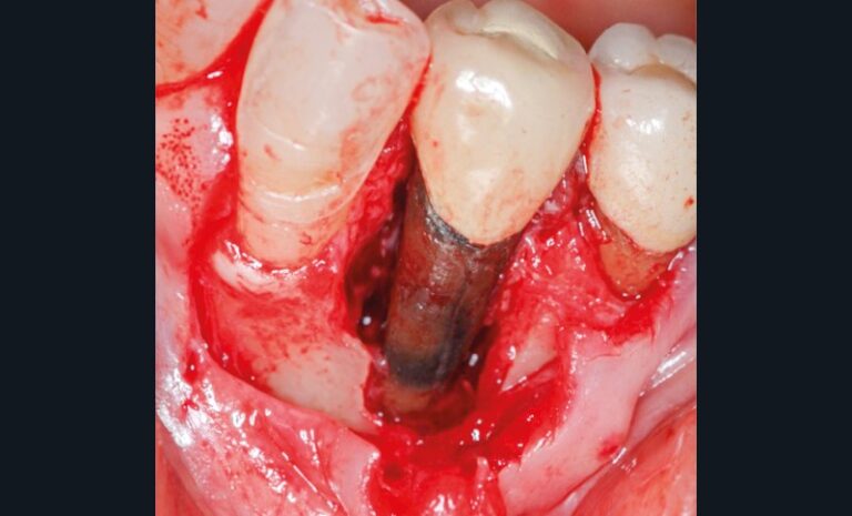 5. Lambeau d’exploration mettant en évidence une fracture radiculaire  au niveau de 35.