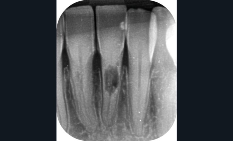 6. Radiographie rétroalvéolaire montrant une résorption interne au niveau de 31 (a).