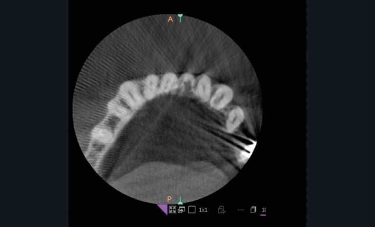 La coupe axiale du CBCT permet d’apprécier la situation linguale de la communication parodontale (b)