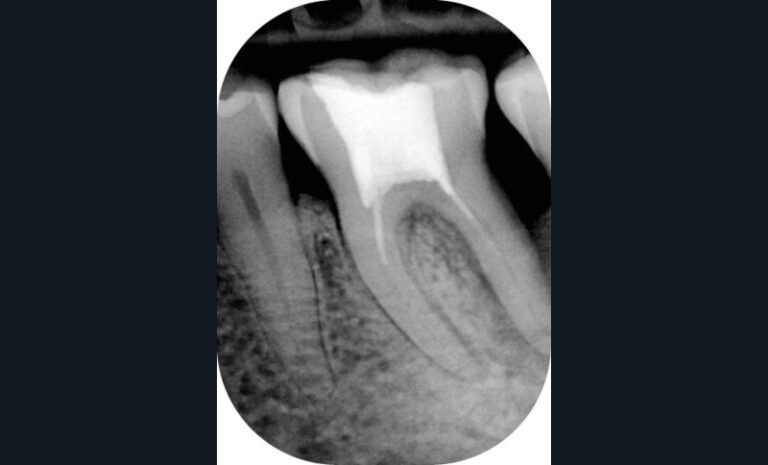 7. Lésion d’origine endodontique au niveau de 36 avec fistulisation cervicale. Radiographie pré-opératoire (a)