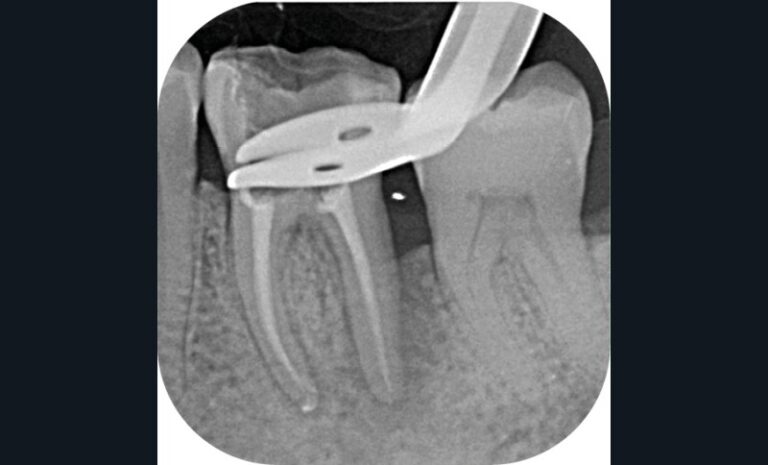 radiographie per-opératoire (b)