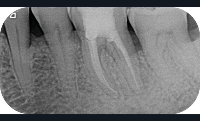 et radiographie à un an (c). La fistule a disparu et le défaut osseux a cicatrisé.