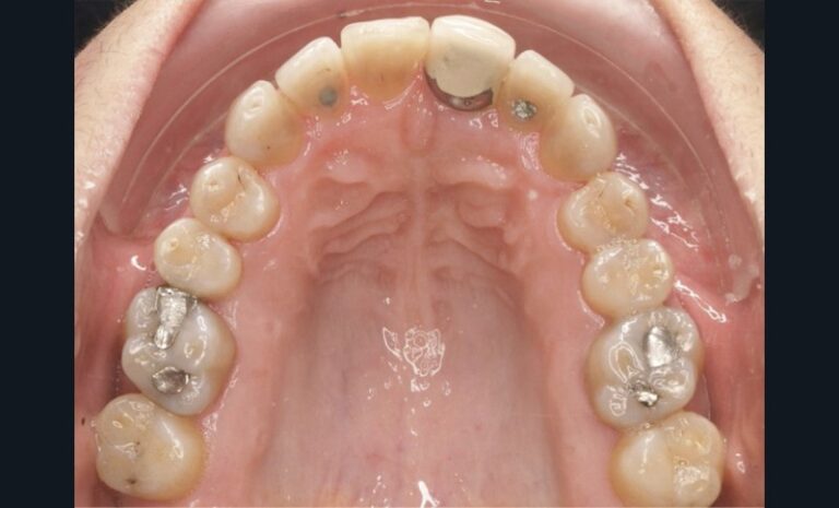 Figure_5_-_Endobuccal_-_Fin_de_traitement1-tt-width-800-height-484-fill-1-crop-0-b