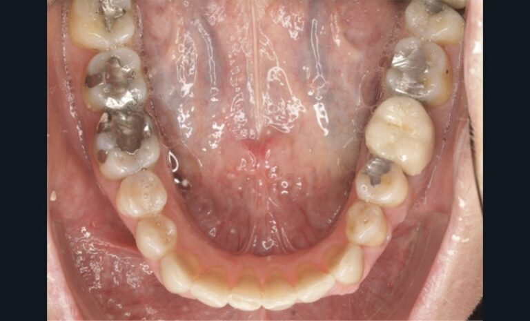 Figure_5_-_Endobuccal_-_Fin_de_traitement3-tt-width-800-height-484-fill-1-crop-0-b