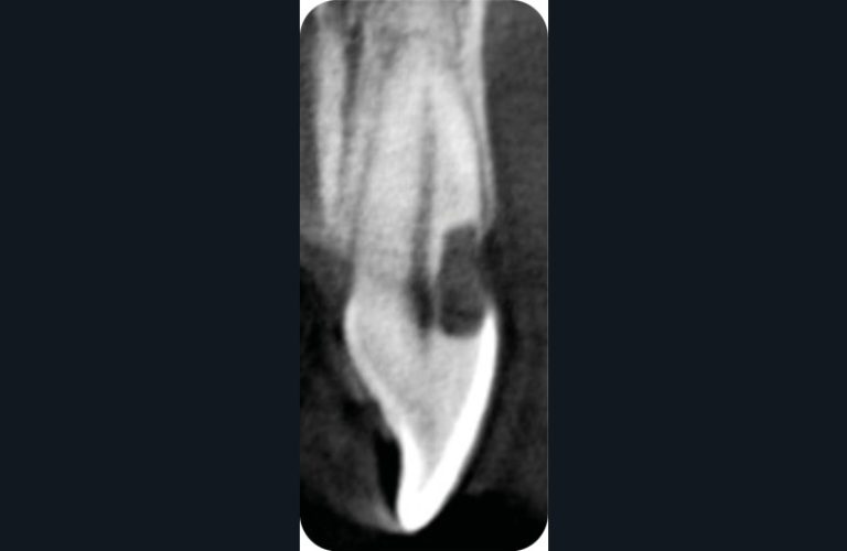 10. Coupes sagitale et axiale d’un CBCT au niveau de 11 montrant la couche de dentine péricanalaire dans le cas d’une résorption cervicale externe